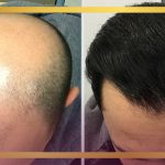 کاشت موی طبیعی بهترین راه حل درمان طاسی