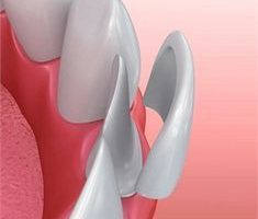 فرایند تعویض لمینت دندان