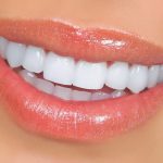 عوارض لمینت دندان چیست؟