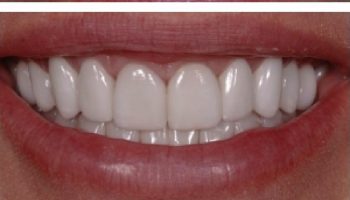 مشکلات شایع ایمپلنت دندان چیست؟