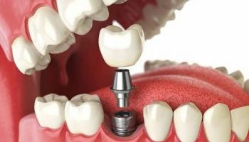 نحوه ترمیم ایمپلنت دندان چگونه است؟