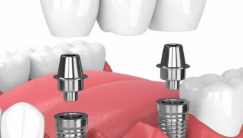 مراقبت از ایمپلنت دندان جلو به چه نحوی است ؟