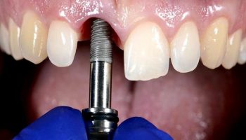 اصلاح دندان کوتاه به چند روش انجام میشود؟