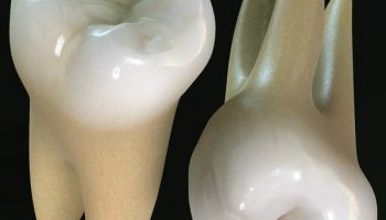 کاشت دندان طبیعی