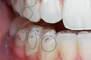 عوارض کاشت بریج دندانی