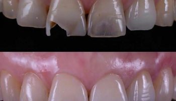 اصلاح شکل دندان