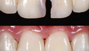 مراحل انجام کامپوزیت دندان به چه صورت است؟
