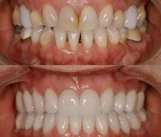 فرایند کامپوزیت پشت دندان