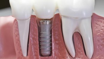 مزایای ایمپلنت دندان جلو چیست؟