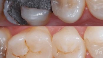 استفاده از لمینت برای اصلاح رنگ دندان