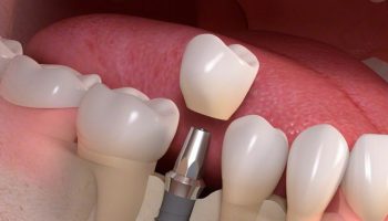 چه زمانی ایمپلنت دندان جلو مورد نیاز میشود؟